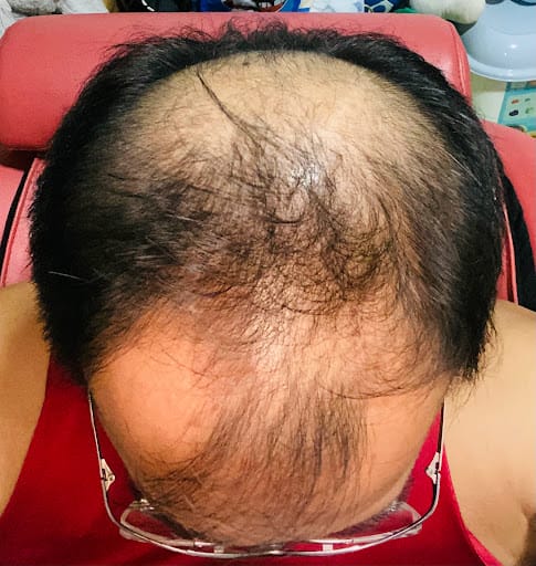 Rehair Lab Singapore - Hair Replacement System For Men